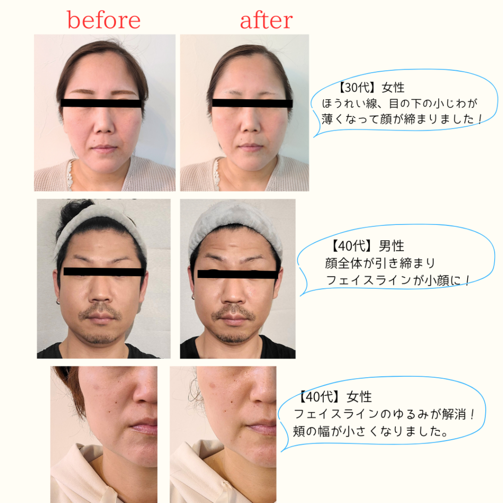 アルファワン　ランボルギーニ美顔器 ランボルギーニ美顔器 ALPHA ONE (アルファワン）シャンパンゴールド