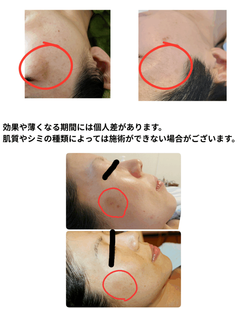 シミ取り2回目の変化写真