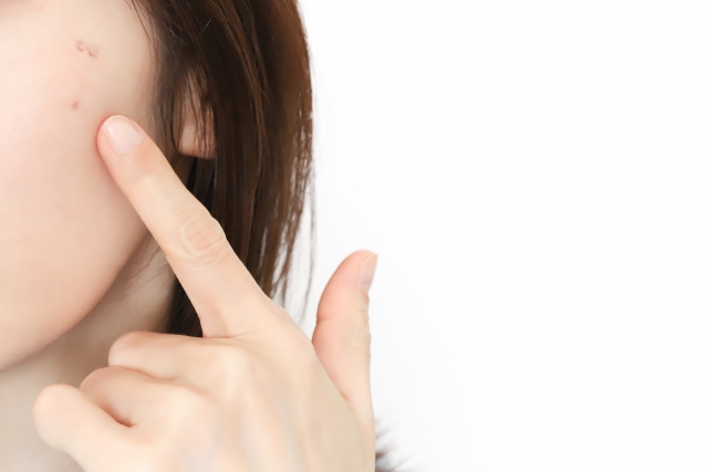 ４０代しみが増える原因