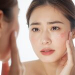 宮崎市のシミ・ニキビ