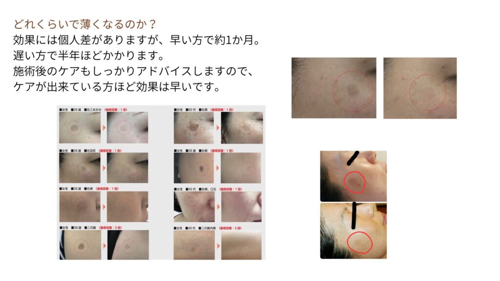 シミ取り経過写真