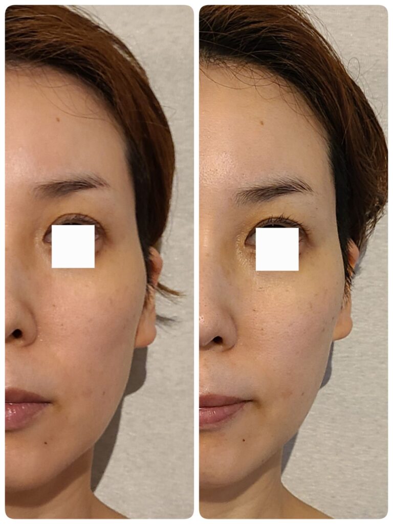 エニシーグローパックフューチャー 使用前後の比較写真」